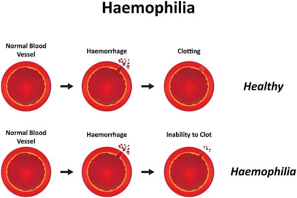 hemolfilia